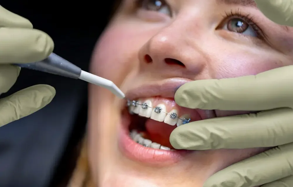 Braces & Aligners – The Ultimate Guide to a Perfect Smile